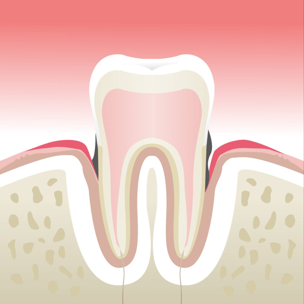 Maladie parodontale stade 3 au cabinet dentaire du Dr Soizic CHERUY-MARTIN