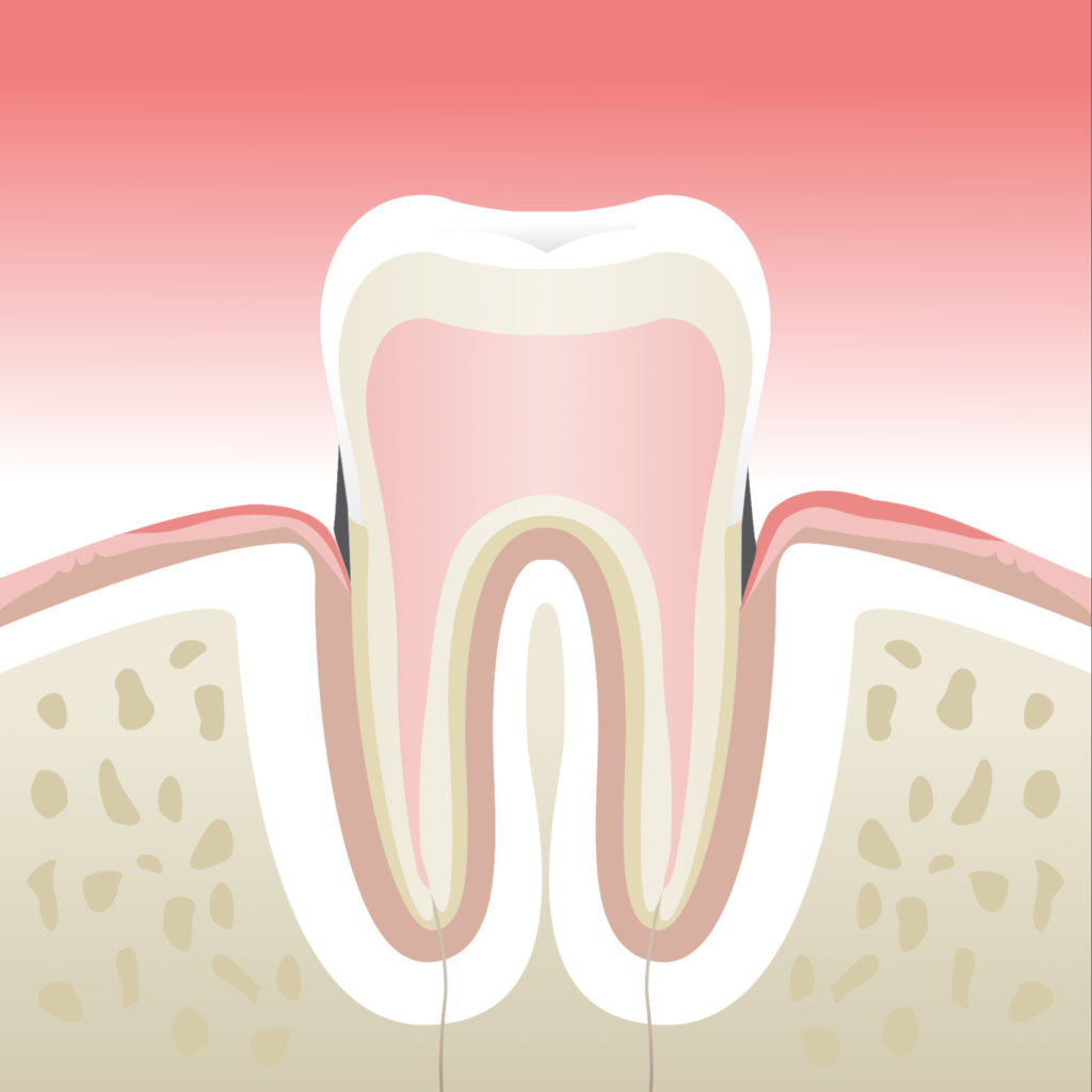 Maladie parodontale stade 2 au cabinet dentaire du Dr Soizic CHERUY-MARTIN